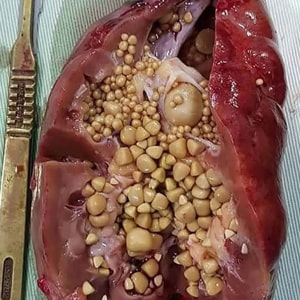 Kidney Stones Treatment in Narasaraopet