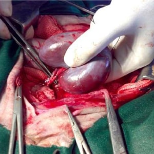 Kidney surgeries in Narasaraopet